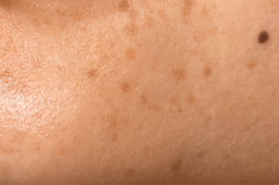 Hyperpigmentation